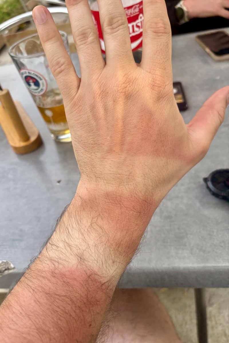 Sunburned hand and arm of hiker.